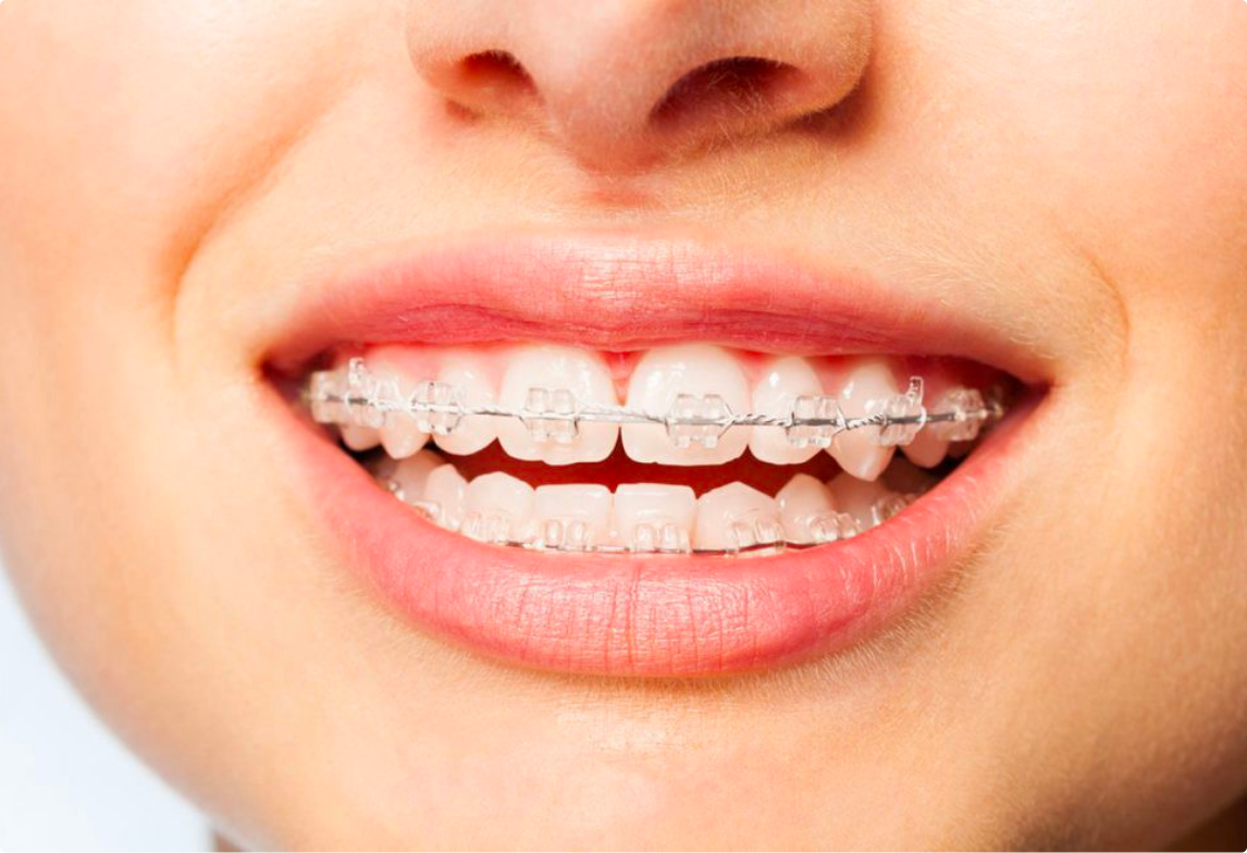 歯列矯正との併用 徳島4kホワイトニング